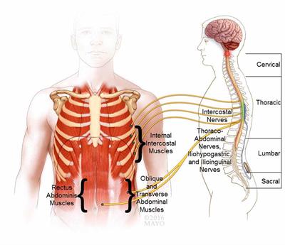 Review of Epidural Spinal Cord Stimulation for Augmenting Cough after Spinal Cord Injury